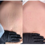 Препарат для мікронідлінгу SKINSCULPT Stretch Marks Formula, 30 мл